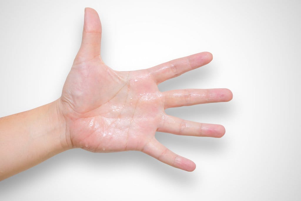 Hyperhidrosis tangan basah dari sindrom keringat. FOTO/iStockphoto Ilustrasi Tangan Berkeringat