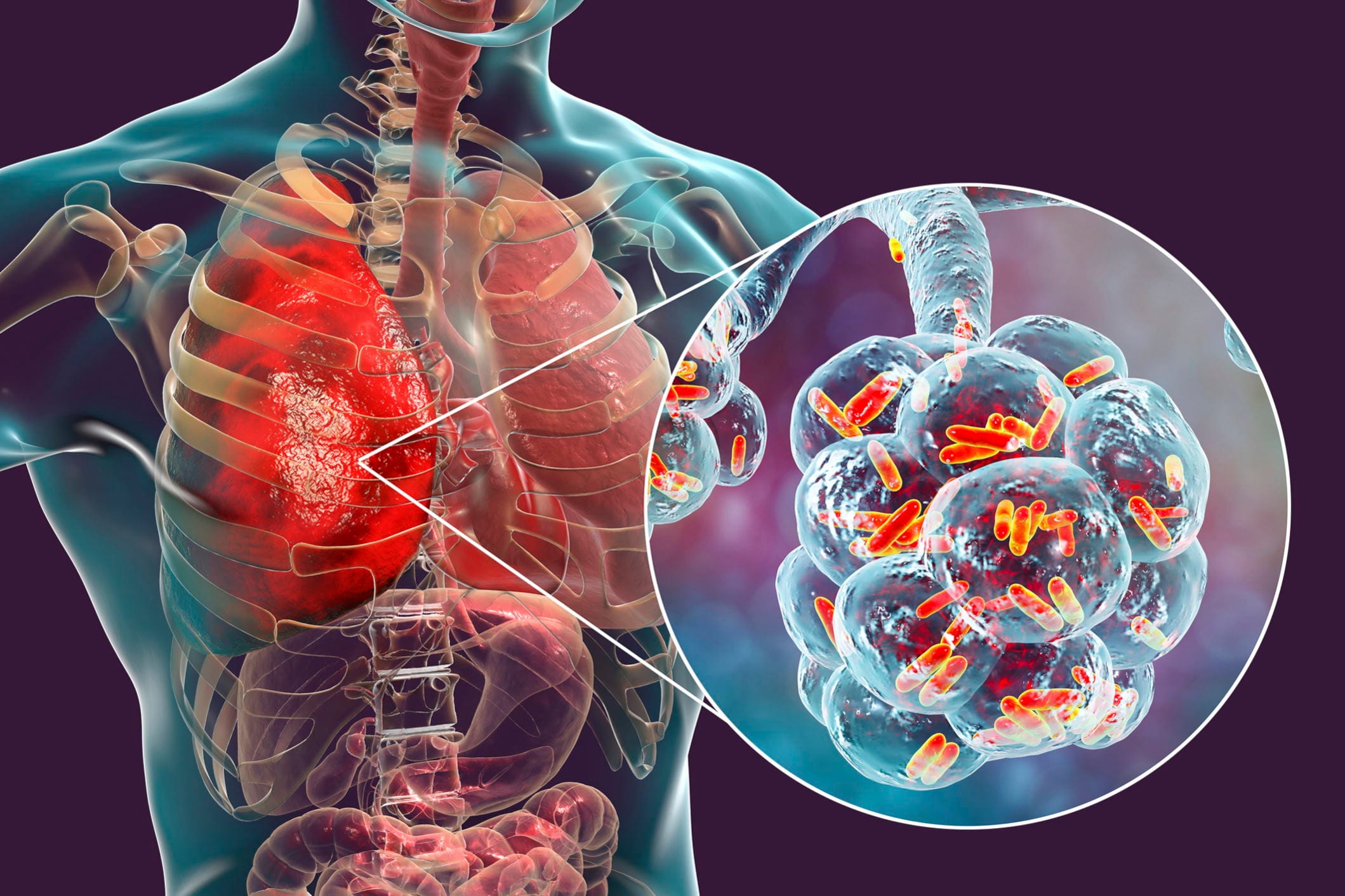 Ilustrasi Pneumonia. FOTO/iStockphoto Ilustrasi Pneumonia