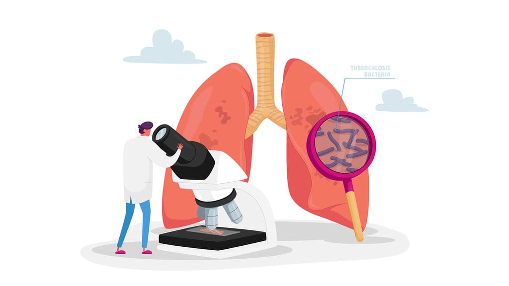 Ilustrasi Tuberkulosis. FOTO/iStockphoto Ilustrasi Tuberkulosis