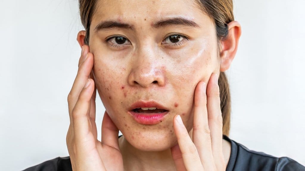 Ilustrasi Skin Barrier Rusak. FOTO/iStockphoto ilustrasi kulit berminyak