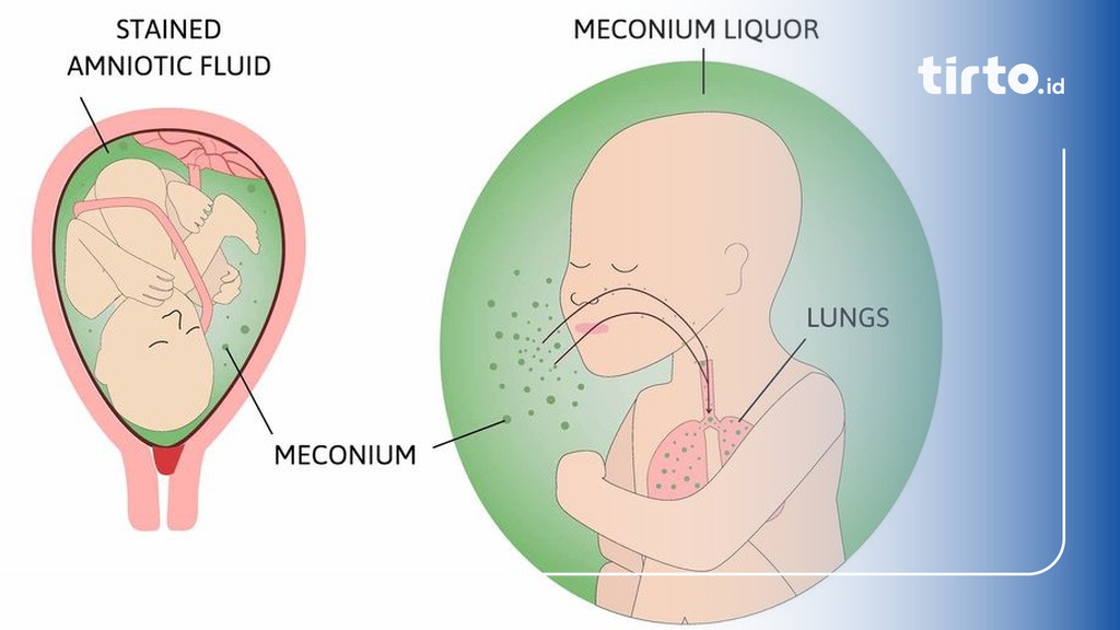 Apa Itu Meconium Aspiration Syndrome Gejala Dan Penyebabnya