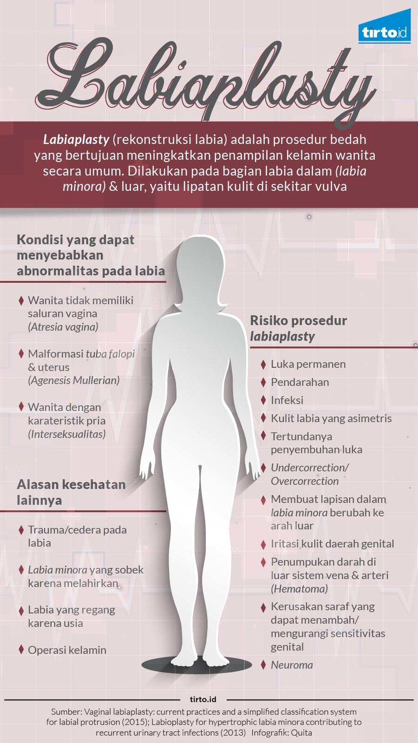 infografik labiaplasty
