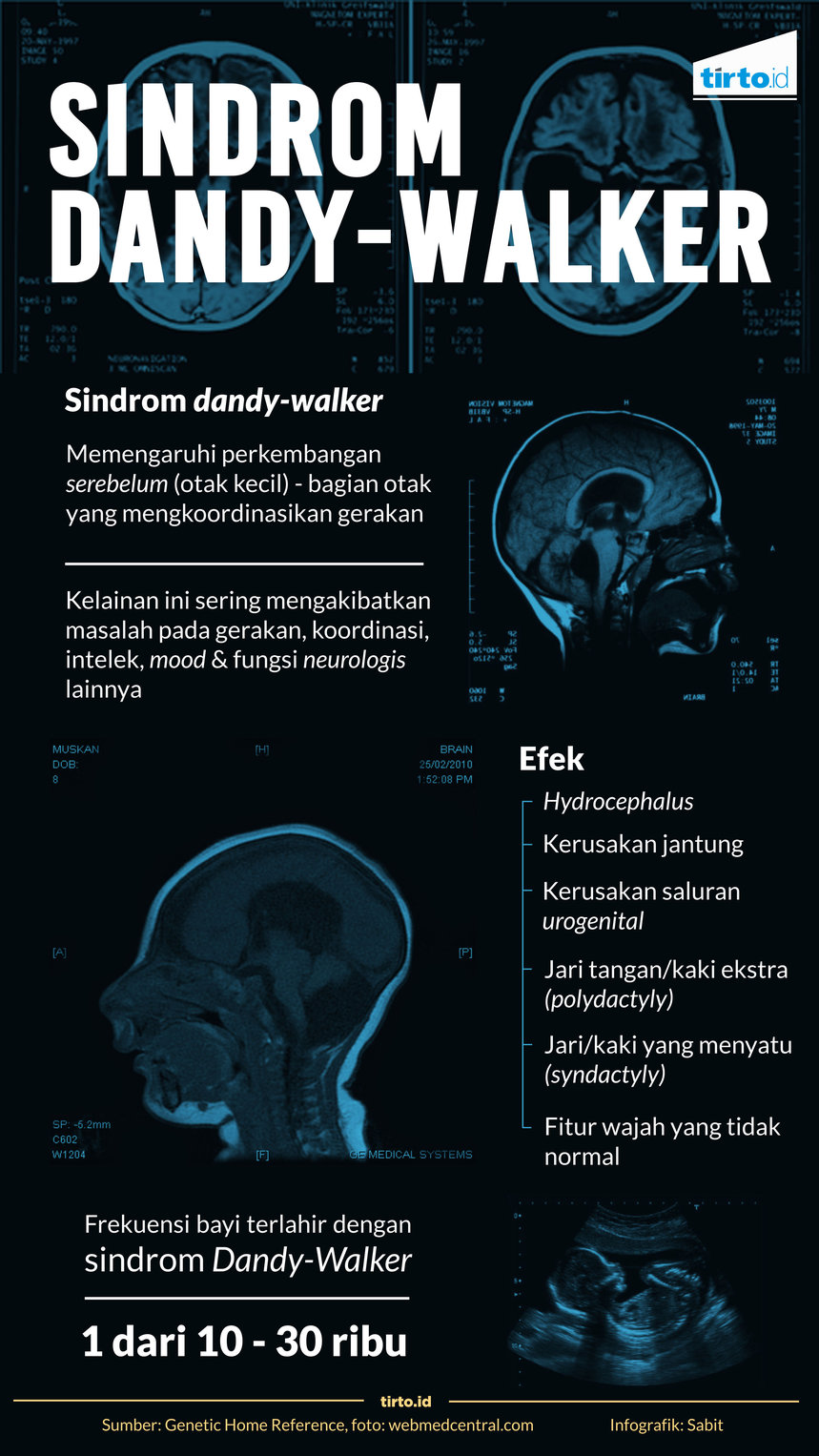 infografik sindrom dandy walker