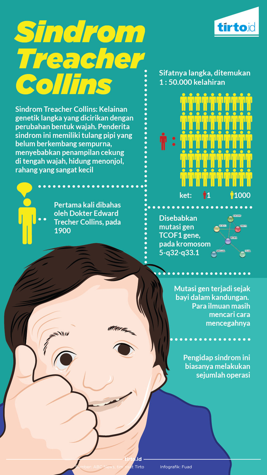 Infografik sindrom treacher collins