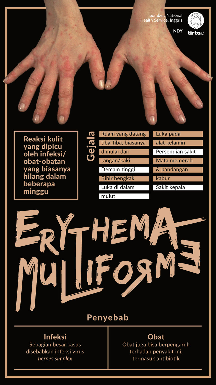Infografik Erythema Multiforme