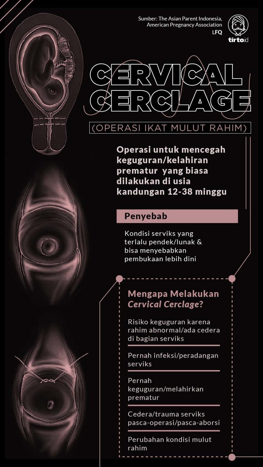 Infografik Cervical Cerclage rev