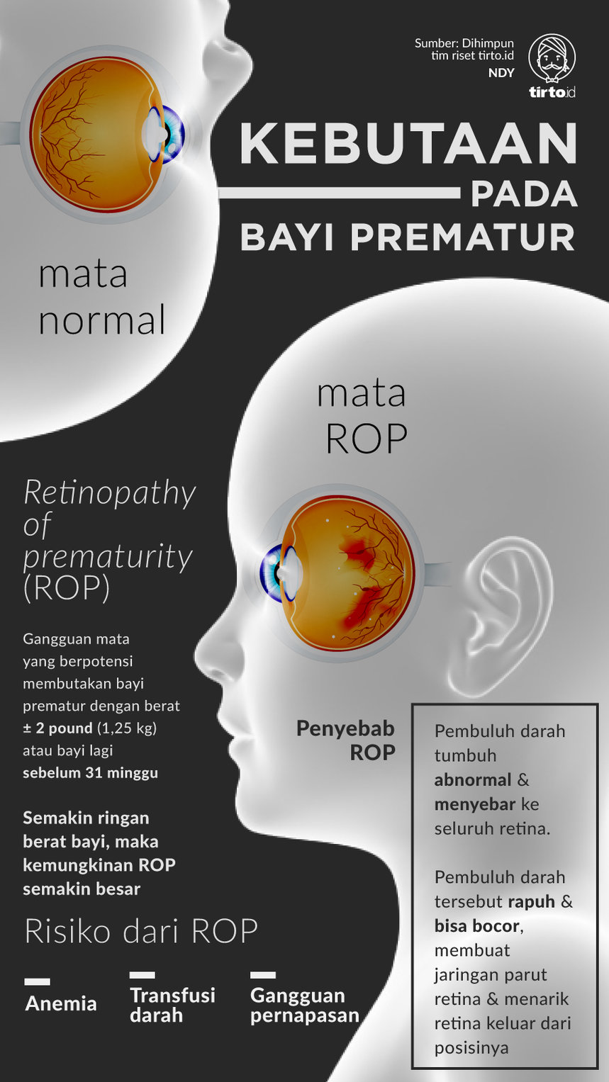 Infografik Kebutaan pada Bayi Prematur