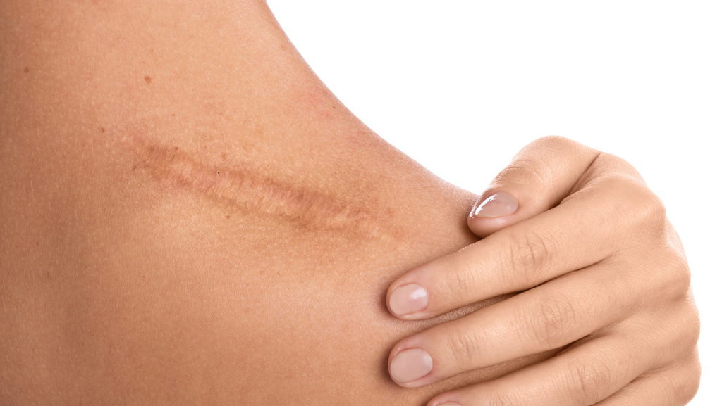 Ilustrasi keloid