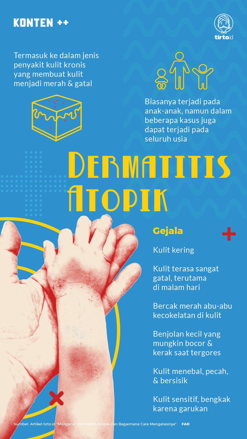 Infografik SC Dermatitis Atopik