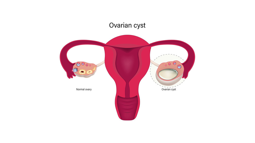 Ilustrasi kista ovarium