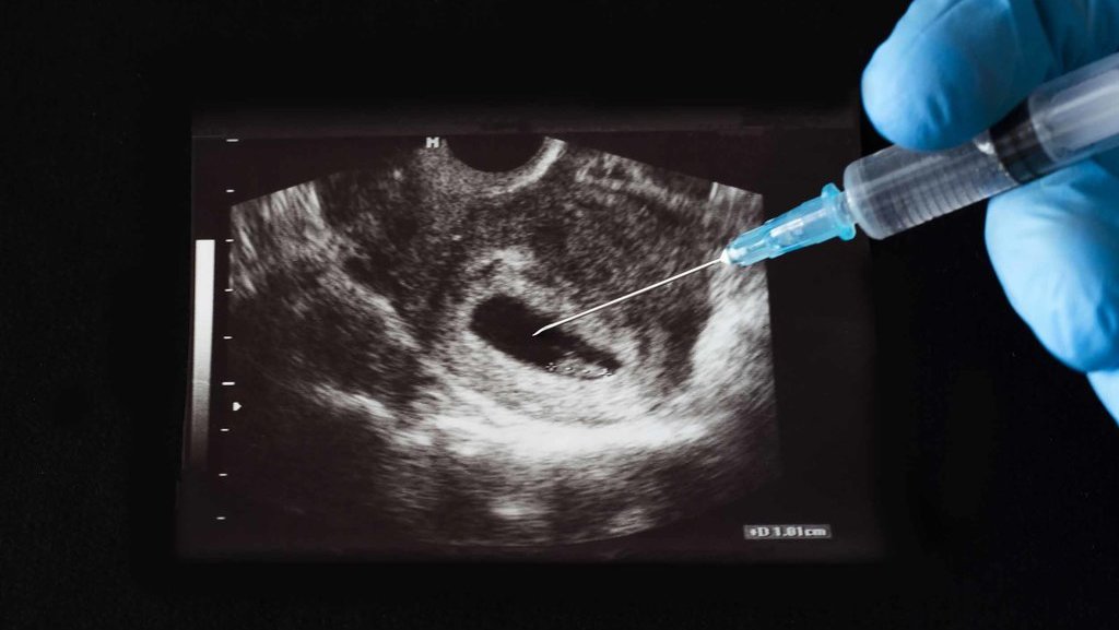 Ilustrasi Aborsi