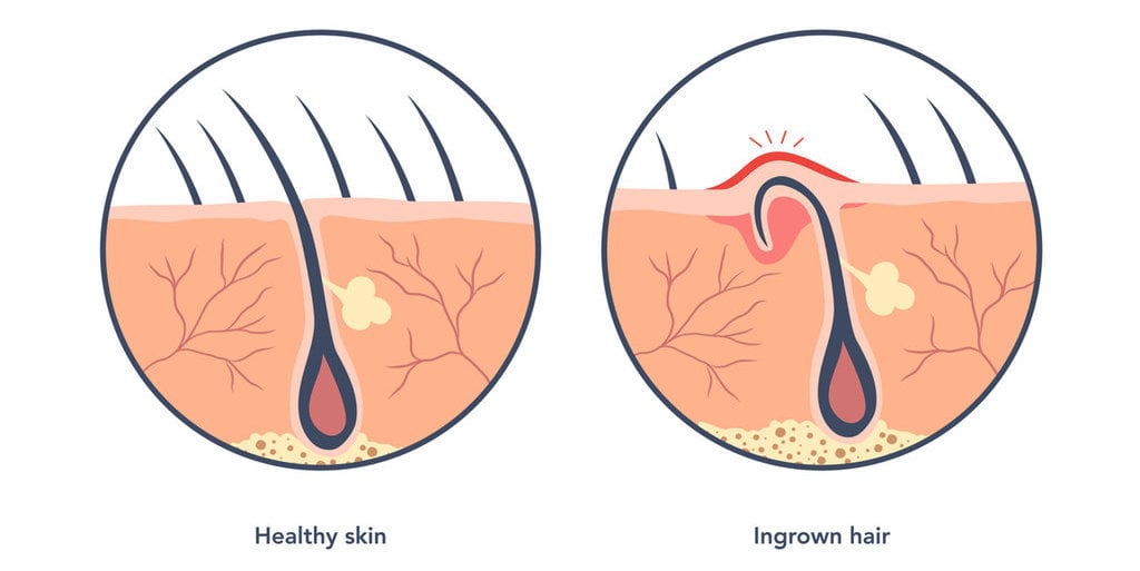 Ilustrasi ingrown hair