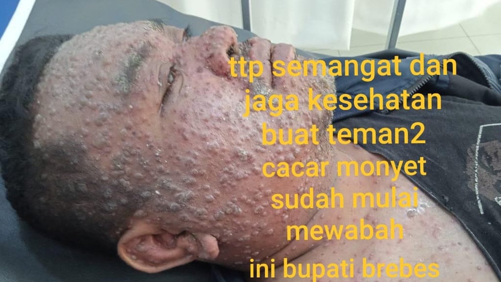 Periksa Fakta PJ Bupati Brebes Terjangkit Mpox