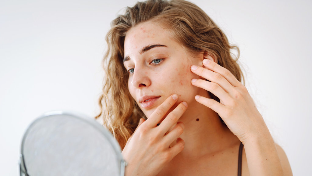 Ilustrasi comedogenic pada skincare