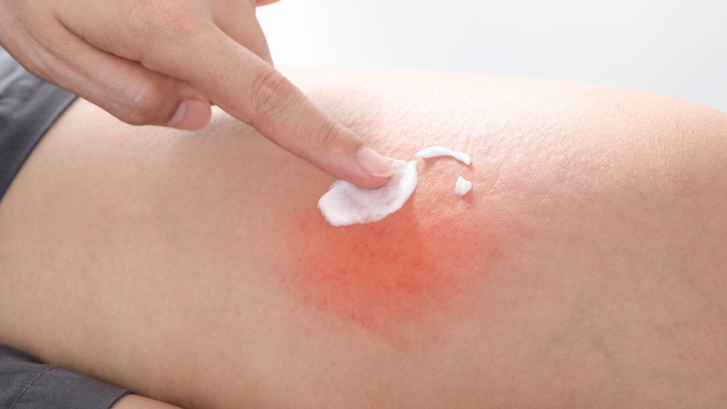 Ilustrasi Capcaisin Krim. foto/istockphoto Ilustrasi Capcaisin Krim