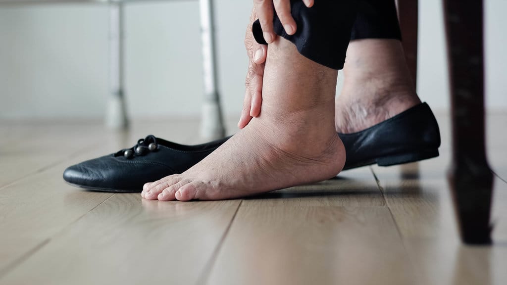 Ilustrasi kaki bengkak karena diabetes.