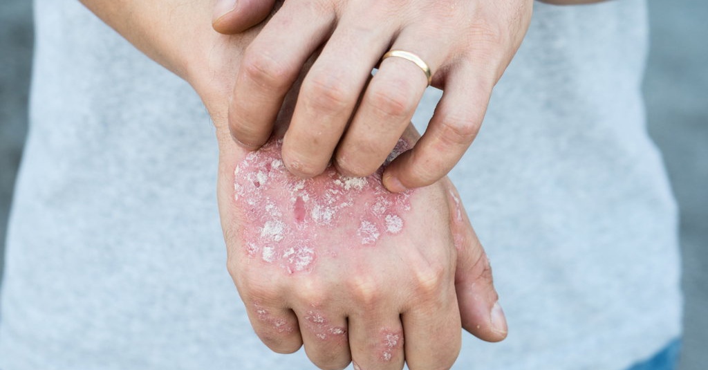  Psoriasis  Penyakit  Kulit  Menahun yang Bisa Diobati dengan 