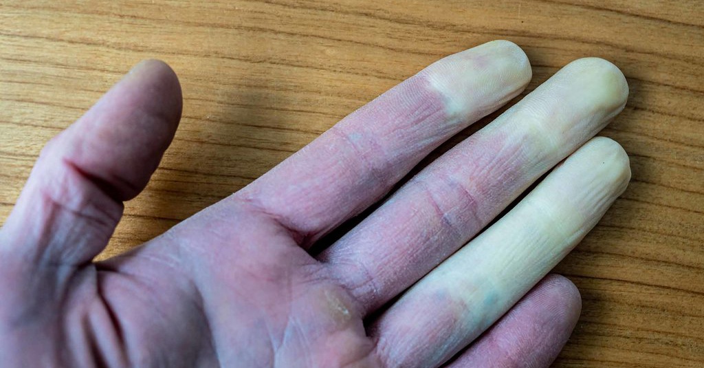 Apa Itu Sindrom Raynaud, Ketahui Daftar Penyebab dan 4 Gejalanya