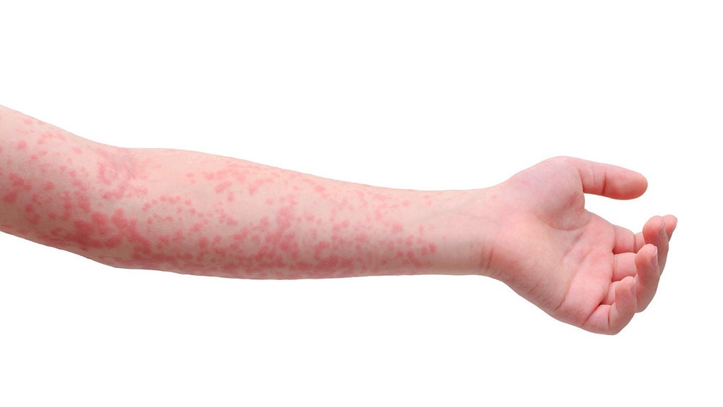 Dermatitis, Kenali Gejala, Penyebab, dan Pencegahannya Dermatitis, Kenali Gejala, Penyebab, dan Pencegahannya