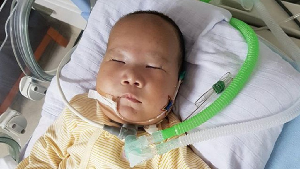Adam Fabumi, Bayi Penderita Dandy-Walker Syndrome Meninggal