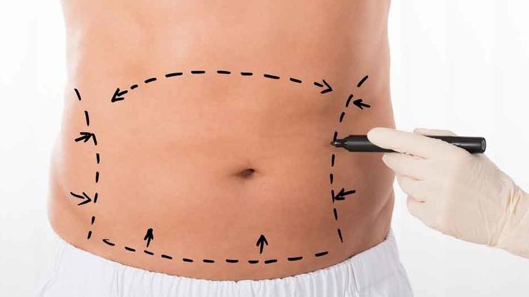 Mengenal Apa Itu Tummy Tuck, Prosedur, Jenis, dan Risikonya Mengenal Apa Itu Tummy Tuck, Prosedur, Jenis, dan Risikonya