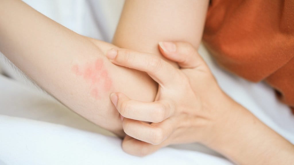 Apa Itu Ringworm? Infeksi Jamur yang Menyerang hingga Kulit Kepala Apa Itu Ringworm? Infeksi Jamur yang Menyerang hingga Kulit Kepala