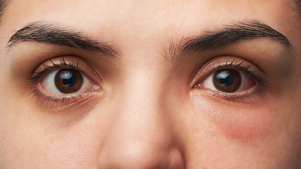 Apa Itu Racoon Eye atau Mata Rakun, Gejala hingga Penyebab Apa Itu Racoon Eye atau Mata Rakun, Gejala hingga Penyebab