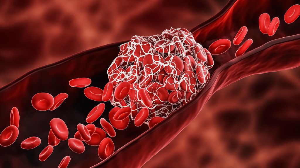 Tema Hari Trombosis Sedunia 13 Oktober 2022 & Apa Itu Trombosis? Tema Hari Trombosis Sedunia 13 Oktober 2022 & Apa Itu Trombosis?