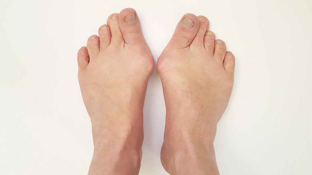 Mengenal Apa Itu Stone Man Syndrome, Penyebab & Tandanya Mengenal Apa Itu Stone Man Syndrome, Penyebab & Tandanya