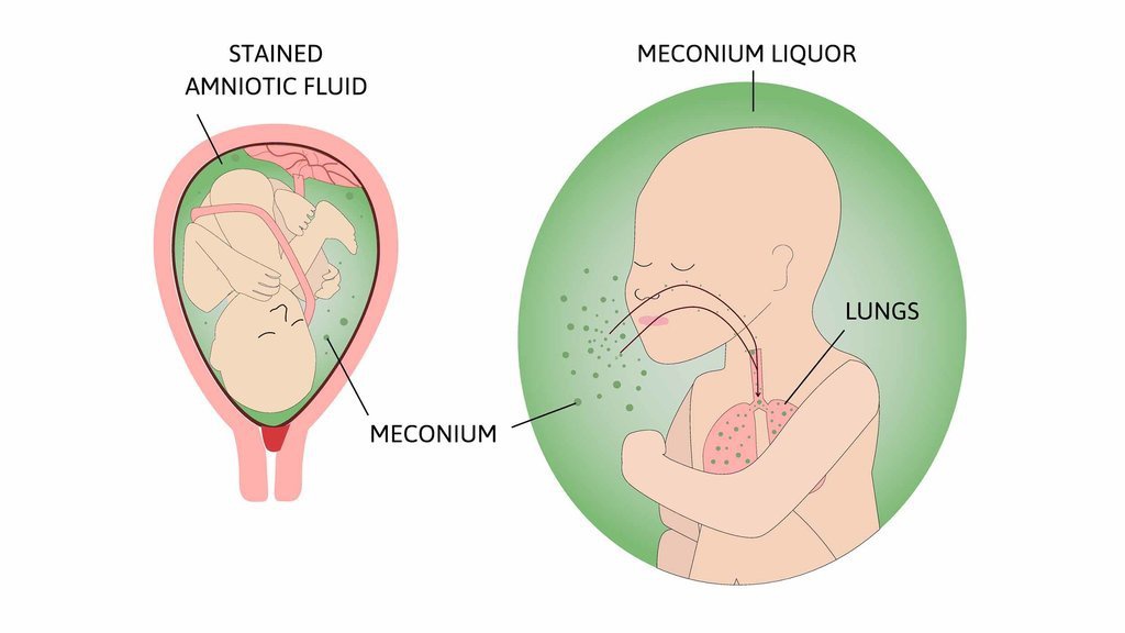 Apa Itu Meconium Aspiration Syndrome, Gejala dan Penyebabnya Apa Itu Meconium Aspiration Syndrome, Gejala dan Penyebabnya