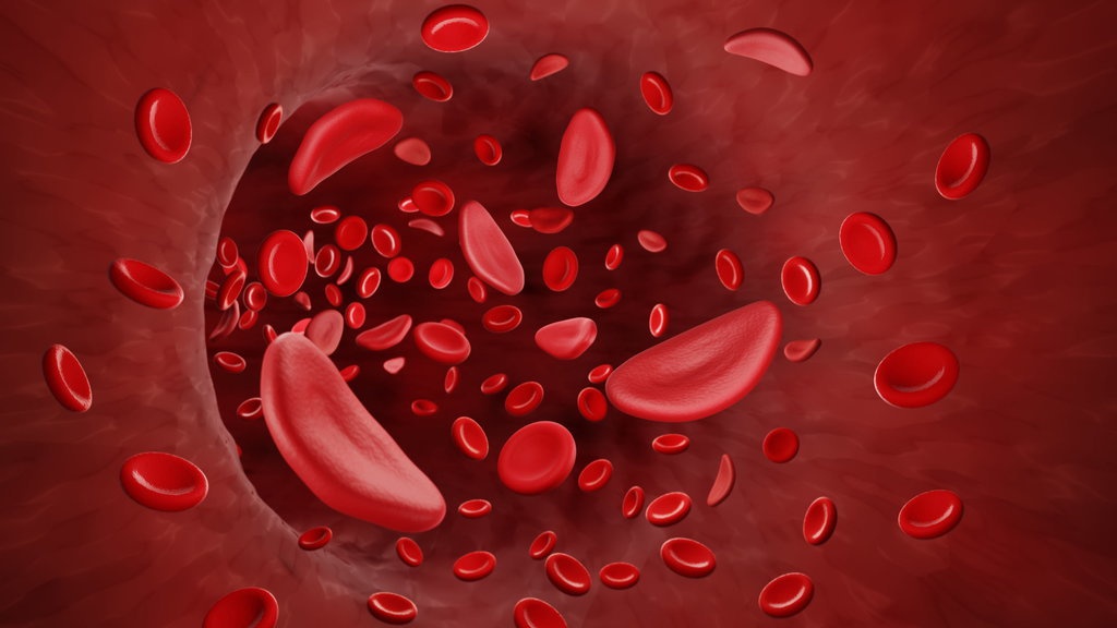 Kenali Penyakit Anemia Sel Sabit, Bisa Berlangsung Seumur Hidup? Kenali Penyakit Anemia Sel Sabit, Bisa Berlangsung Seumur Hidup?
