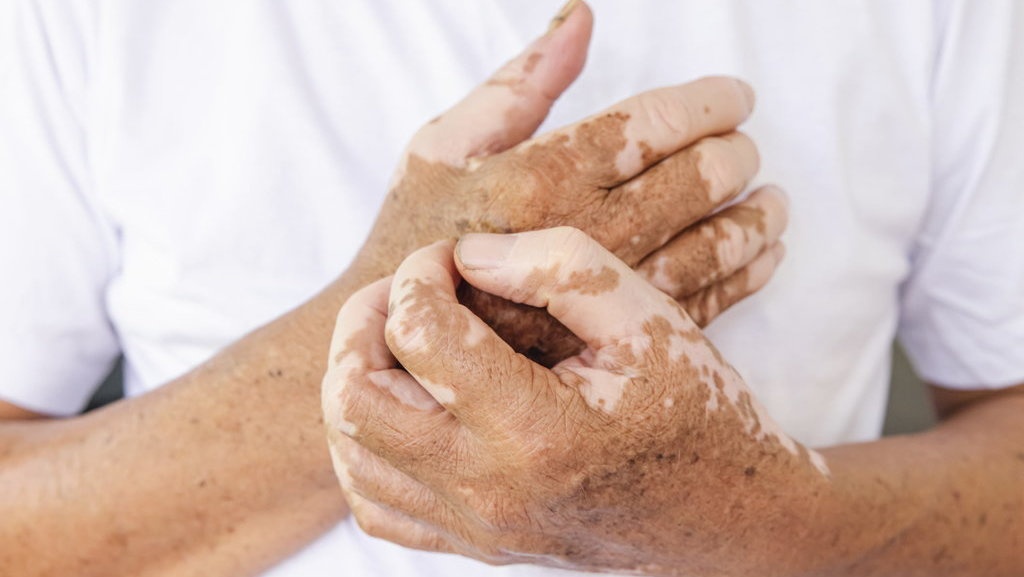Apa Itu Penyakit Vitiligo. Ketahui Penyebab & Cara Mengobatinya Apa Itu Penyakit Vitiligo. Ketahui Penyebab & Cara Mengobatinya