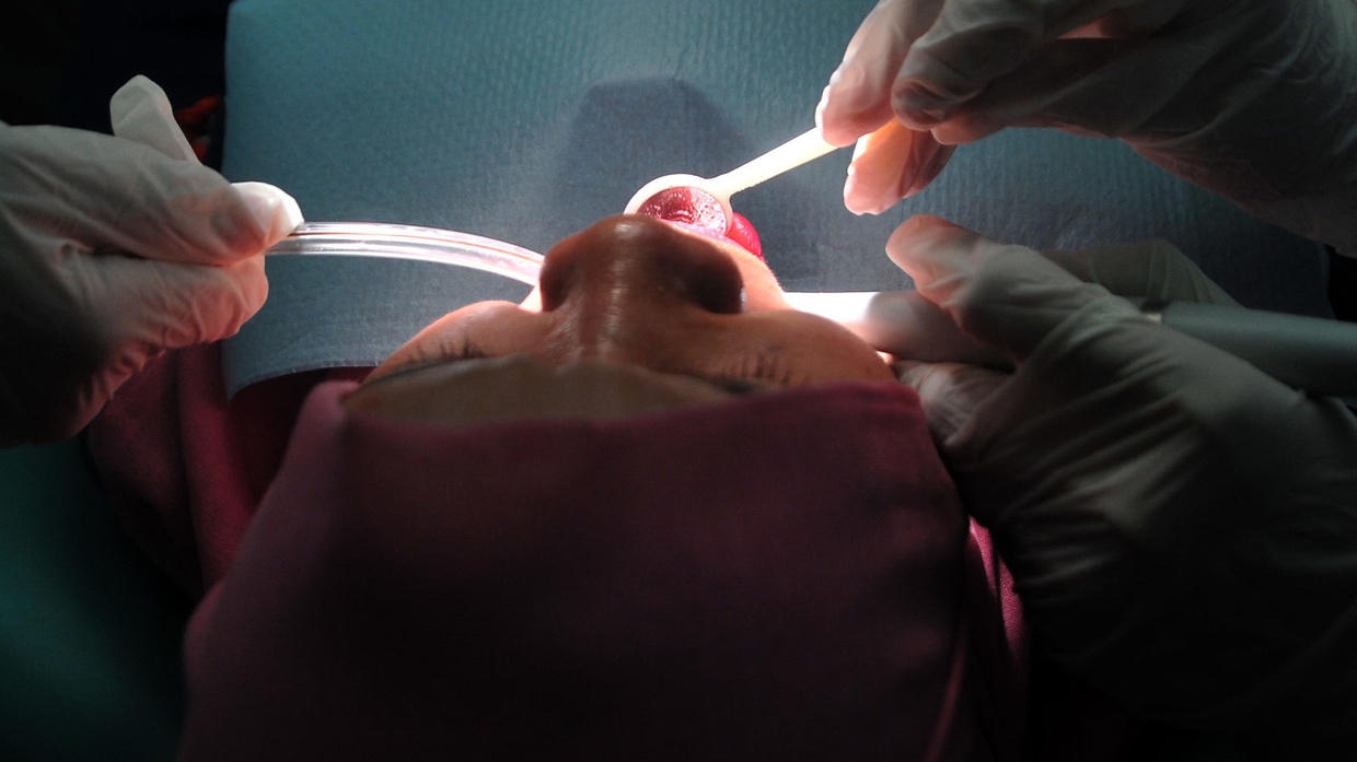 Ciri Kanker Mulut, Penyebab hingga Cara Mencegah Kanker Mulut