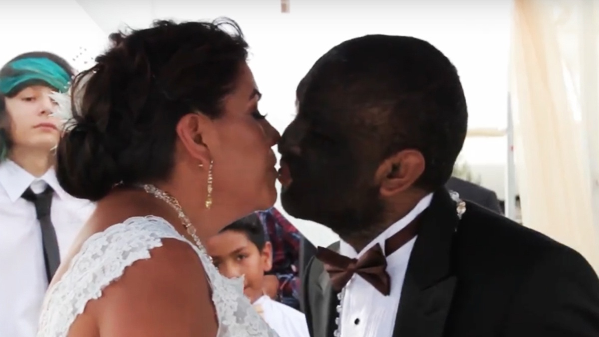 Penyakit yang Menginspirasi Kisah Beauty and The Beast