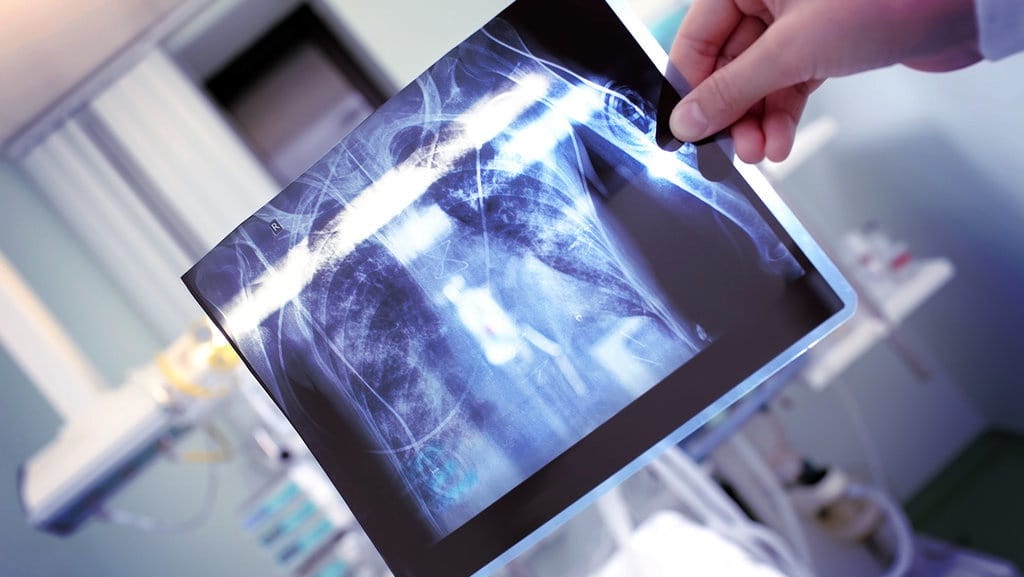 Indonesia Masih Saja Bergelut dengan Tuberkulosis Indonesia Masih Saja Bergelut dengan Tuberkulosis