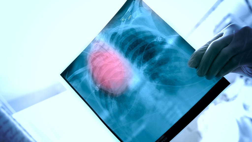 Lagi, Tuberkulosis Hantui Eropa: Salah Imigran?