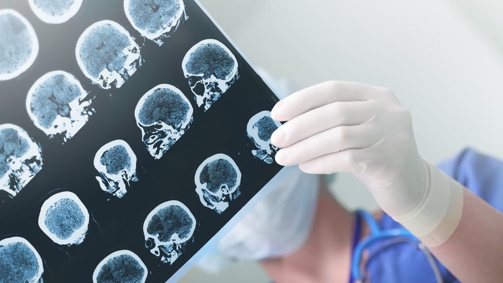 Gejala Awal Stroke yang Harus Diwaspadai Menurut Dokter Gejala Awal Stroke yang Harus Diwaspadai Menurut Dokter