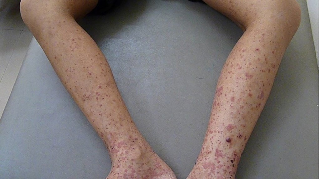 Awas, Gigi Berlubang Bisa Picu Henoch-Schonlein-Purpura (HSP) Awas, Gigi Berlubang Bisa Picu Henoch-Schonlein-Purpura (HSP)