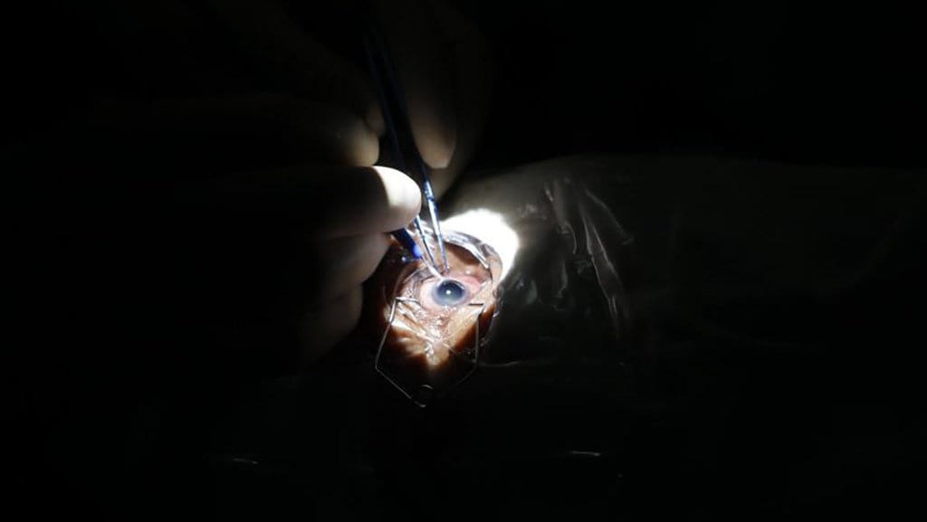 Prosedur Operasi Lasik, Biaya dan Ketahui Risikonya Prosedur Operasi Lasik, Biaya dan Ketahui Risikonya