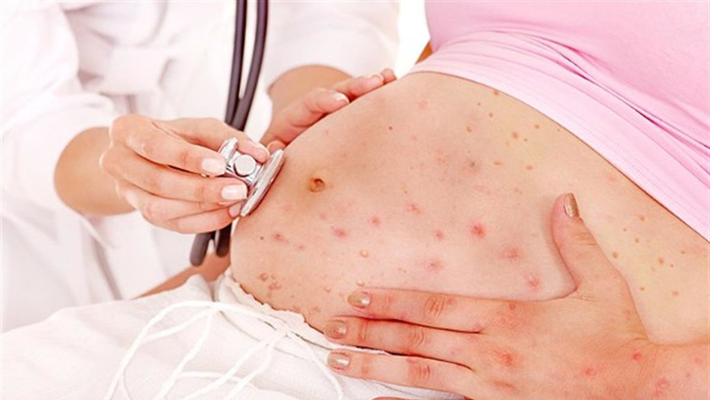 Di Balik Pentingnya Vaksinasi Rubella Di Balik Pentingnya Vaksinasi Rubella