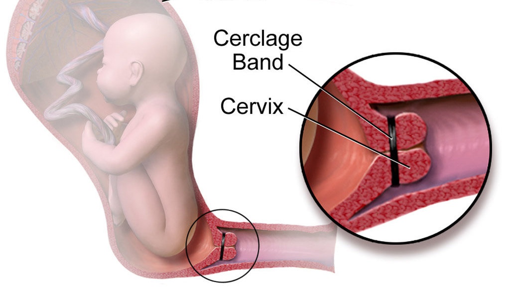 Cegah Keguguran dengan Operasi Ikat Rahim Cegah Keguguran dengan Operasi Ikat Rahim