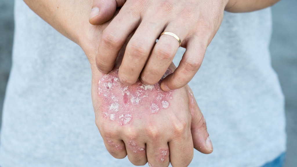 Psoriasis, Penyakit Kulit Menahun yang Bisa Diobati dengan Ganja Psoriasis, Penyakit Kulit Menahun yang Bisa Diobati dengan Ganja