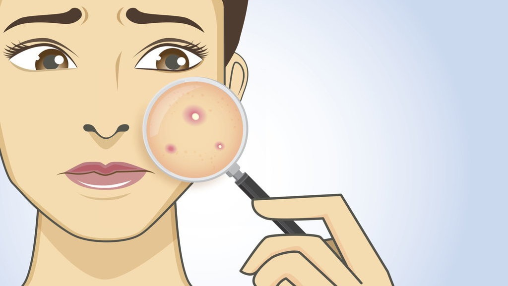 7 Rekomendasi Produk Eksfoliasi Wajah Berminyak & Berjerawat