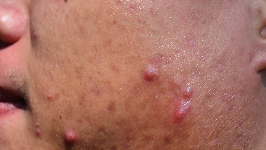 Apa Itu Wajah Breakout, Penyebab, dan Cara Mengatasinya? Apa Itu Wajah Breakout, Penyebab, dan Cara Mengatasinya?
