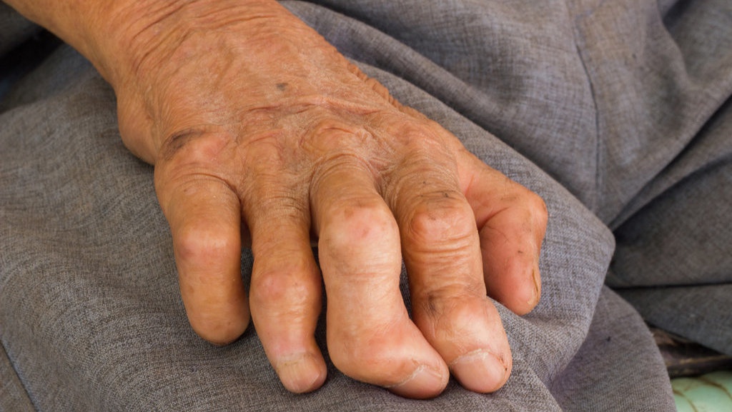 Kemenkes Waspadai Sejumlah Penyakit Tropis di Indonesia Kemenkes Waspadai Sejumlah Penyakit Tropis di Indonesia