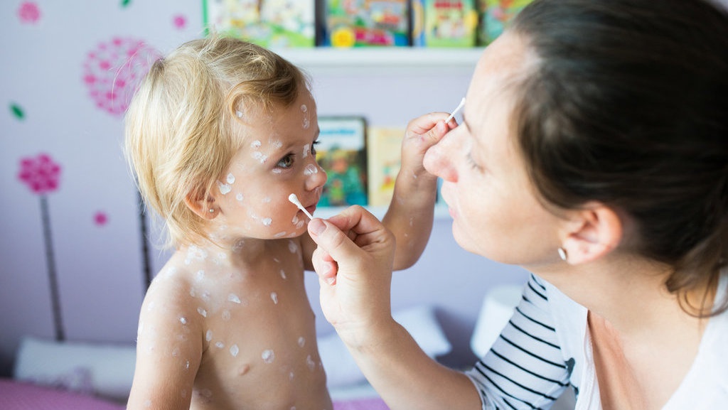 Kasus Cacar Monyet di Singapura: Kenali Penyebab dan Pengobatannya Kasus Cacar Monyet di Singapura: Kenali Penyebab dan Pengobatannya