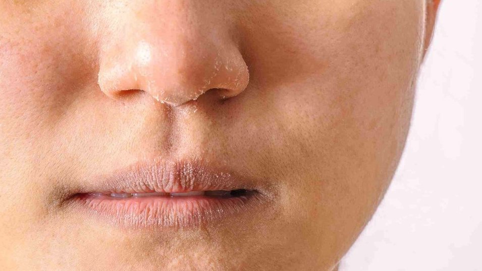 Ketahui 9 Cara Mengatasi Kulit Kering dan 7 Penyebabnya