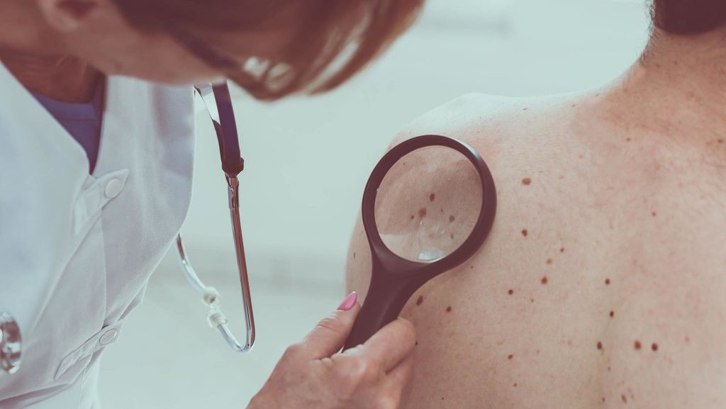 Apa Itu Melanoma Monday? Cek Tujuan Peringatannya Apa Itu Melanoma Monday? Cek Tujuan Peringatannya