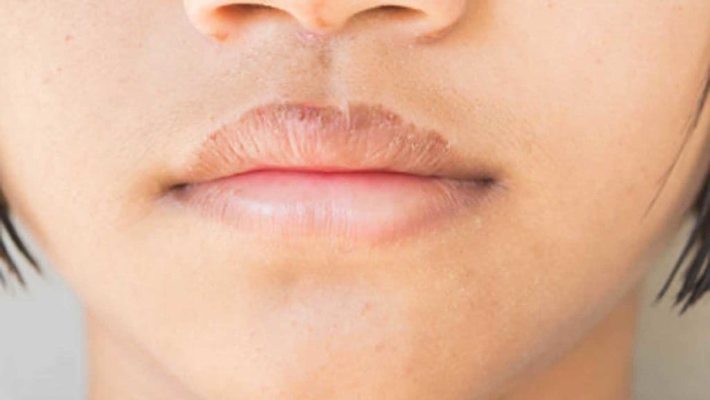 Kemungkinan Penyakit dengan Gejala Bibir Pecah-pecah