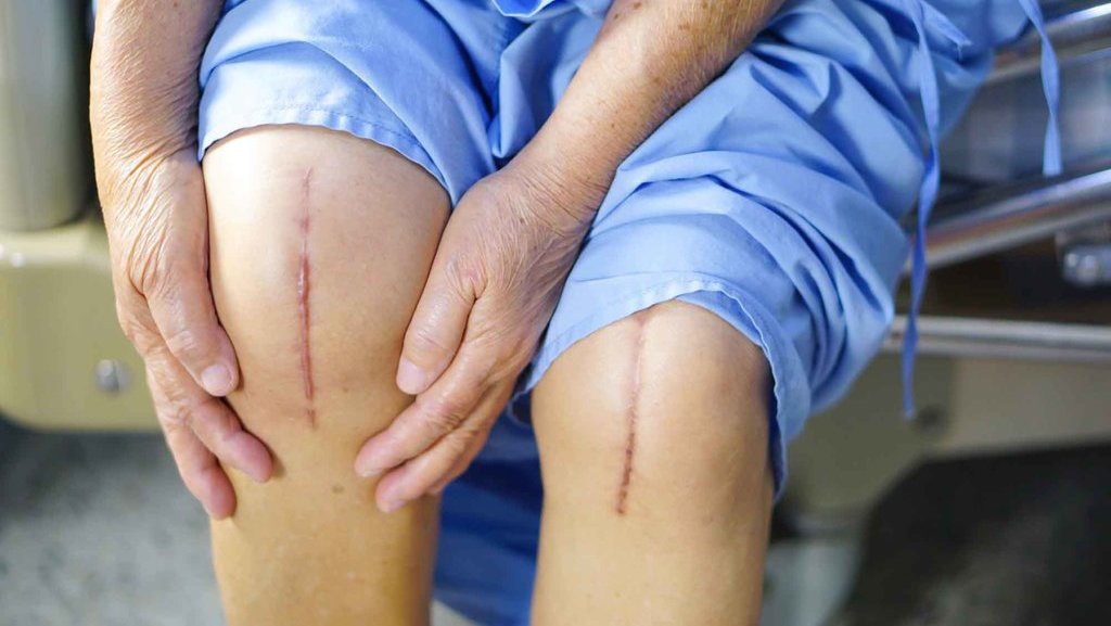 Cara Menyamarkan Bekas Luka Operasi Cara Menyamarkan Bekas Luka Operasi